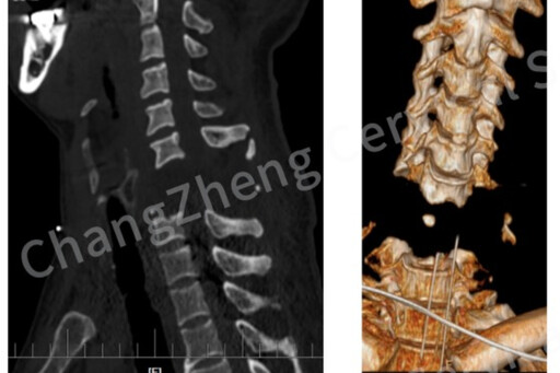 死神手中搶人!患者遭重擊「身首斷離」瀕死 上海醫療團隊奇蹟救活