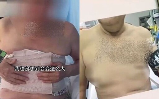 狂嗑花生、瓜子！大叔胸部「罩杯升級」 醫揭驚人原因