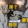 「泡泡尿」藏致命危機！ 醫一看嚇壞：腸子接到膀胱了