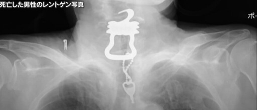 喉嚨痛竟是卡鑰匙！日本老翁亡 死因卻是新冠