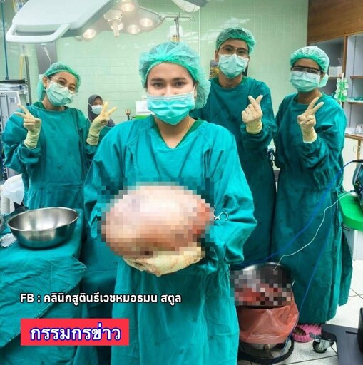 泰國女腹脹以為吃太多！手術竟挖出「8公斤卵巢囊腫」 震驚醫界