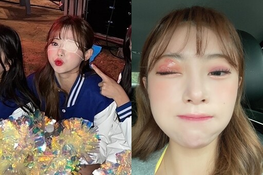 金娜妍每天僅睡2小時出事了！得皮蛇「眼睛在灼燒」 恐留永久疤痕