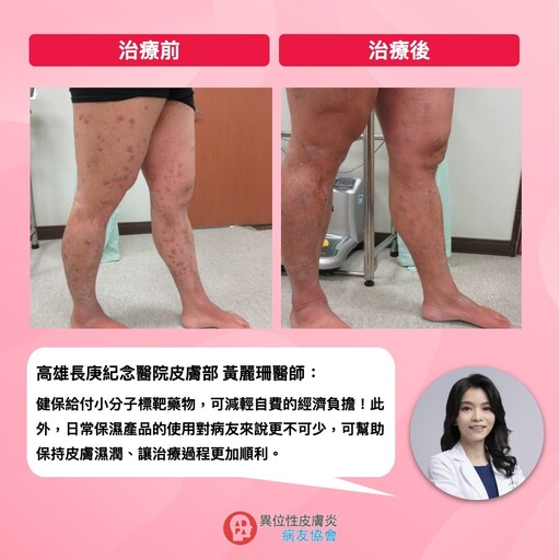 異位性皮膚炎癢到徹夜難眠？靠健保給付小分子標靶藥物找回生活節奏
