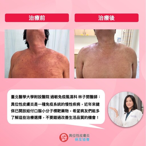 異位性皮膚炎癢到徹夜難眠？靠健保給付小分子標靶藥物找回生活節奏