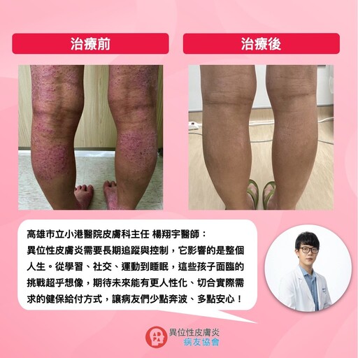 異位性皮膚炎癢到徹夜難眠？靠健保給付小分子標靶藥物找回生活節奏