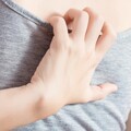 乾癬竟致親密關係受損？醫：及早治療助解決