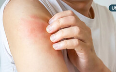 異膚治療不中斷！健保新藥想要「再上車」 病友該怎麼做？