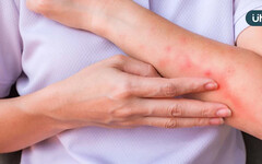 異位性皮膚炎治療新趨勢 生物製劑到生活調適 找回穩定自信