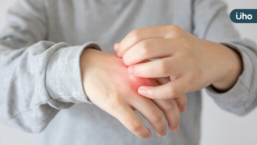 20歲男大生乾癬疾病延燒關節誤認痛風 醫籲提早控制發炎為關鍵