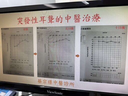 年青女性患突發性耳聾 中醫即時介入以針灸及中藥治療改善聽力下降