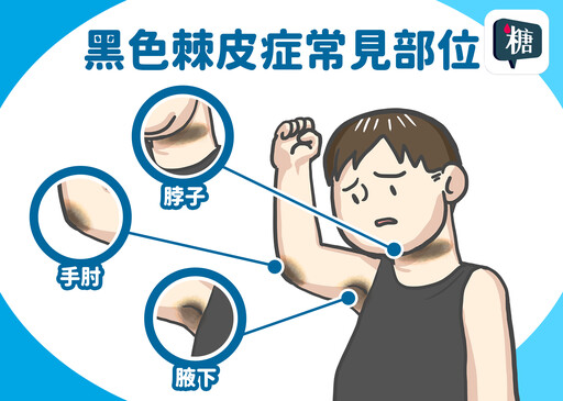 逆轉糖尿病前期有訣竅 醫：「減脂」、「增肌」、「控糖」關鍵3大招！