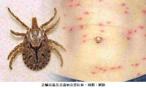 夏季恙蟲來襲!民眾提高警覺保健康