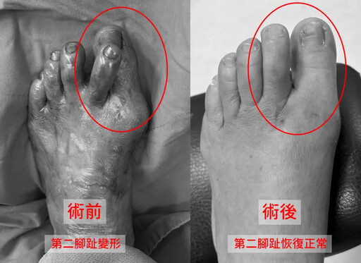 拇指外翻「變形翹起」 醫：沒治療恐害脫臼