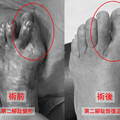 拇指外翻「變形翹起」 醫：沒治療恐害脫臼