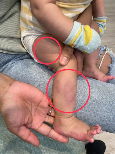 童疑遭保母不當對待 婦幼局：已廢止登記證