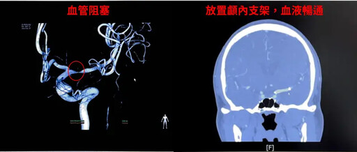 男右側突沒力!年輕型中風「找無病因」