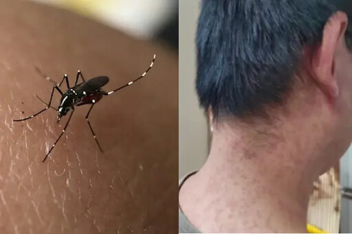 屈公病恐釀大流行?疾管署澄清:不會人傳人
