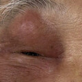 84歲爺右眼腫痛！送急診「急性鼻竇炎」