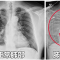 65歲女嗜睡、胃口差！送醫一照：雙肺全白