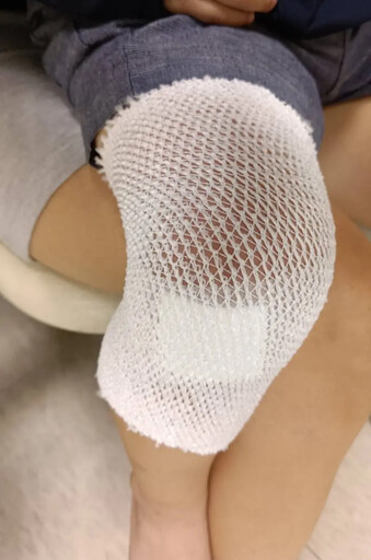 彰化幼兒園爆虐童!孩童私處撕裂、膝遭插針