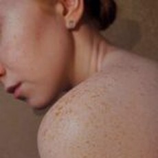 蕁麻疹成因不只過敏 除了食物還有這5大誘發因素