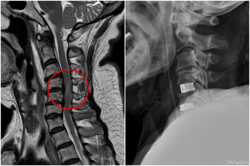 花慈脊椎內固及融合微創手術助脊髓損傷康復