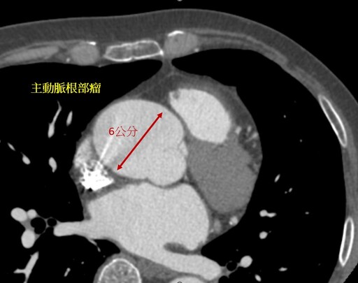 意外發現大顆主動脈瘤 北慈開心手術除瘤修瓣膜