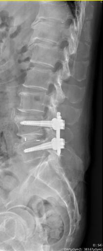 微創手術治療腰椎滑脫 瓦解下背痛讓病人充滿驚喜