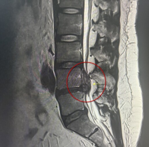 體重破百男椎間盤突出 脊椎內視鏡手術除病灶
