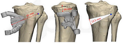 台北慈院3D列印客製化脛骨截骨矯正術