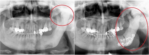 骨骼異常增生致無法張嘴 北慈首例顎骨冷凍治療結合3D導航解噩夢