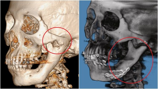 骨骼異常增生致無法張嘴 北慈首例顎骨冷凍治療結合3D導航解噩夢