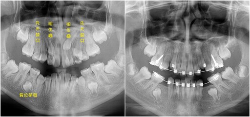 先天異常致女童缺牙亂牙 早期矯正提升自信心
