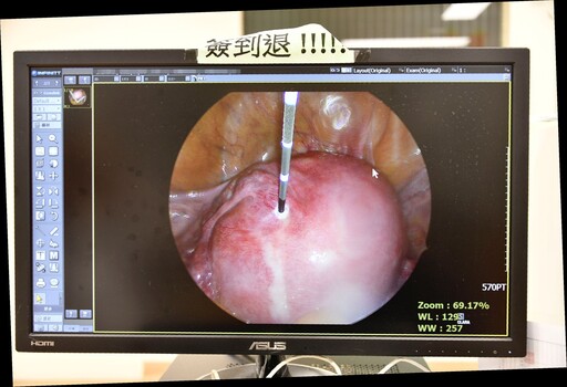 大林慈院創新微波消融術治療子宮肌(腺)瘤傷口小
