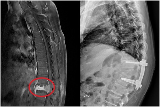 雙腳無力竟是脊椎椎體骨腫瘤 脊椎手術除病灶