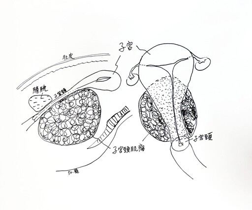 肌瘤位置緊貼子宮內頸 花慈達文西手術幫大忙