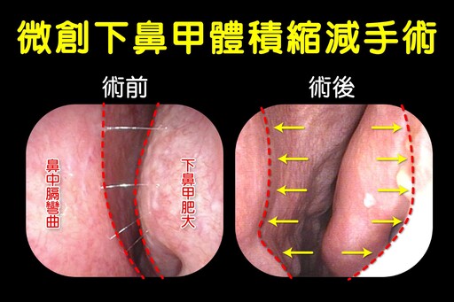 阻斷後鼻神經縮減下鼻甲 打鼾女戰勝鼻過敏