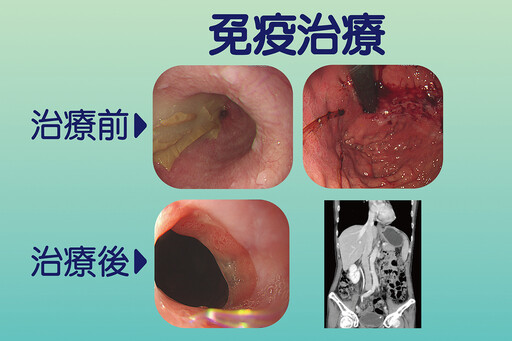 翻轉棘手胃癌 台中慈濟成績緊追日韓