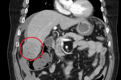 腹痛難耐竟是早期肝癌 沉默器官不可輕忽