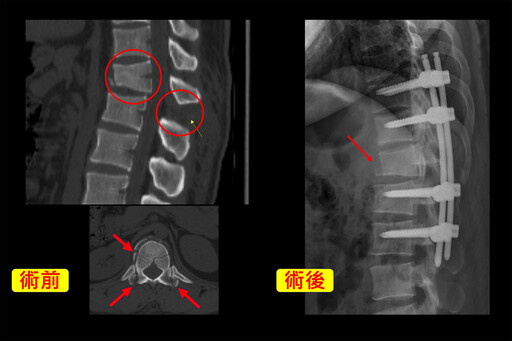 少見脊椎屈曲牽張性骨折 中慈微創手術助康復