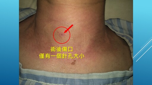 上班族頸腫瘤近四公分 消融術除病灶保留器官