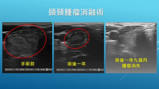 上班族頸腫瘤近四公分 消融術除病灶保留器官