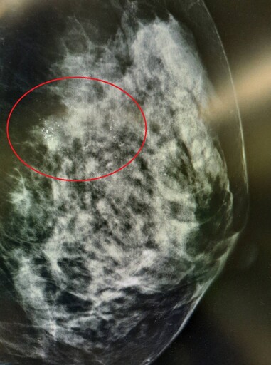 整合腫瘤切除與重建 提升乳癌患者治療生活品質