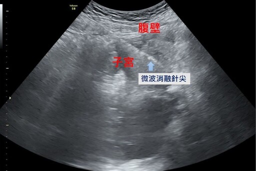 經痛難耐原是子宮肌腺瘤作祟 微波消融手術治療解除病灶