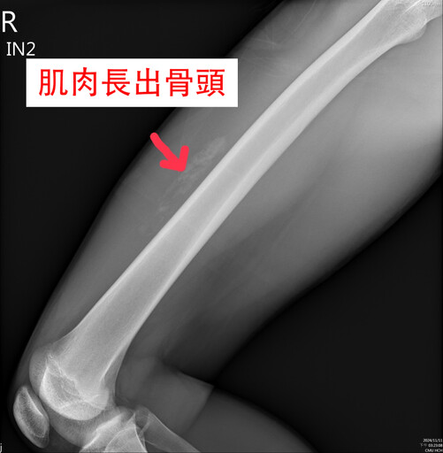 「吃雞腿」竟引發骨化性肌炎｜青少年籃球傷害引發醫界關注