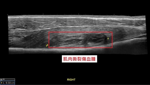 「吃雞腿」竟引發骨化性肌炎｜青少年籃球傷害引發醫界關注