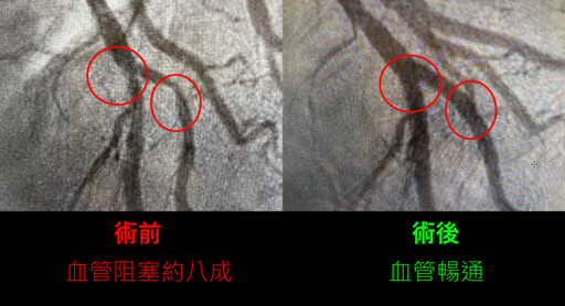 呼吸困難竟是心臟病徵兆｜新竹醫療團隊成功救回老農