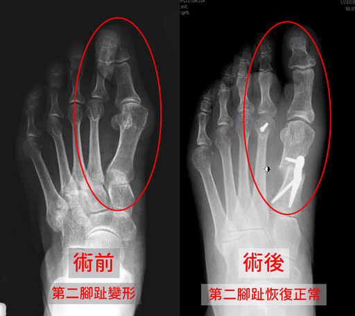 婦女腳趾變形疼痛難行 微創手術矯正拇指外翻重獲行動自由