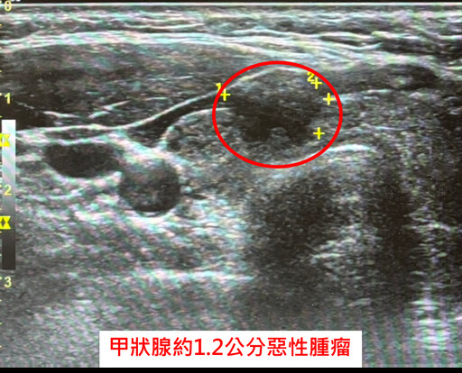 甲狀腺癌患者接受全切除手術 中醫大新竹附醫提醒術後留意低血鈣症狀