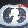 肺結核患者罹癌風險200倍 新竹附醫提醒篩檢
